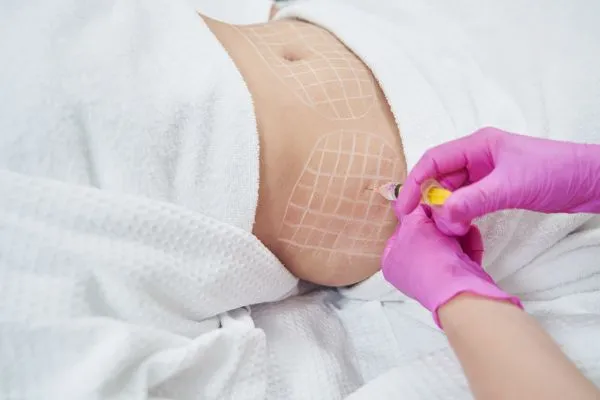 image of fat dissolving injections on love handles to help combat weight gain Bedfordshire