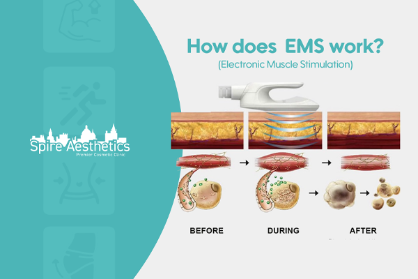 EMS treatment for post pregnancy weight loss treatment Bedfordshire