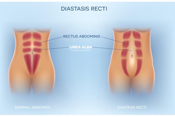 What Non-Surgical Options Are Available for Diastasis Recti Bedfordshire?