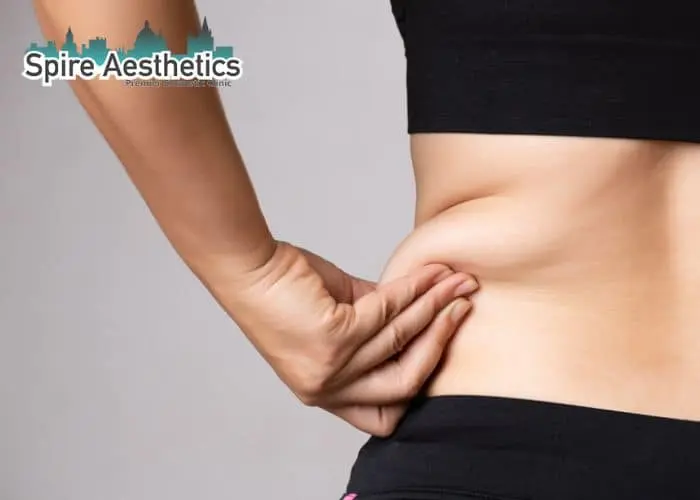 Image of woman pinching fat on their hips Bedfordshire. Fat Freezing treatment
