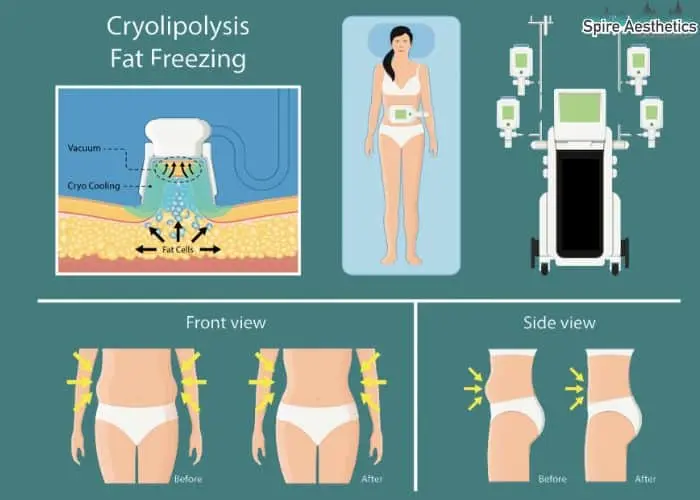 Fat freezing treatment Bedfordshire benefits for competitions to remove stubborn fat deposits.
