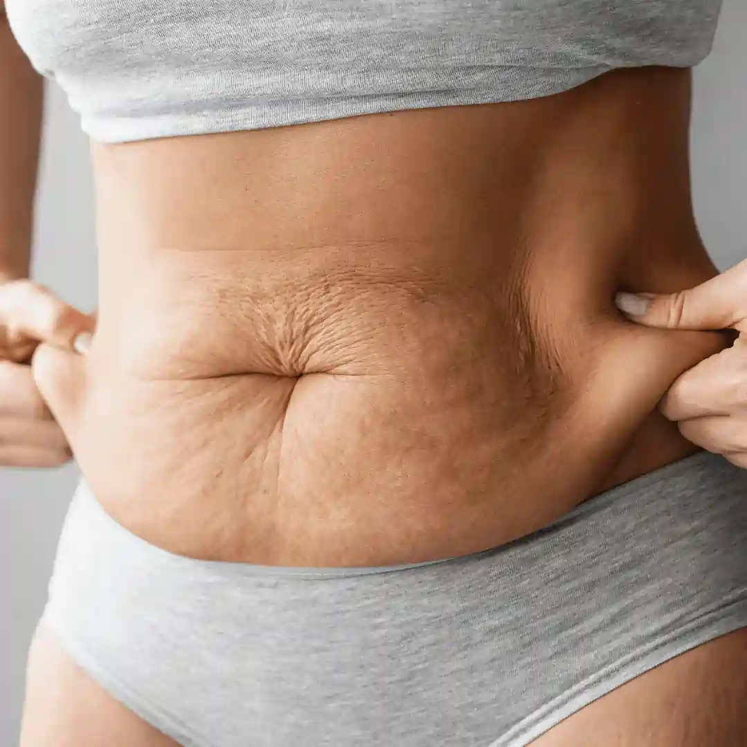 Is It Normal to Have Loose Skin After Pregnancy Bedfordshire?