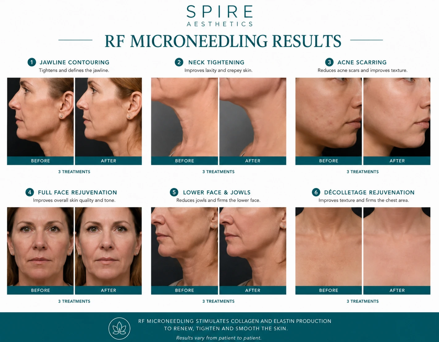 RF Microneedling Skin tightening Bedfordshire results
