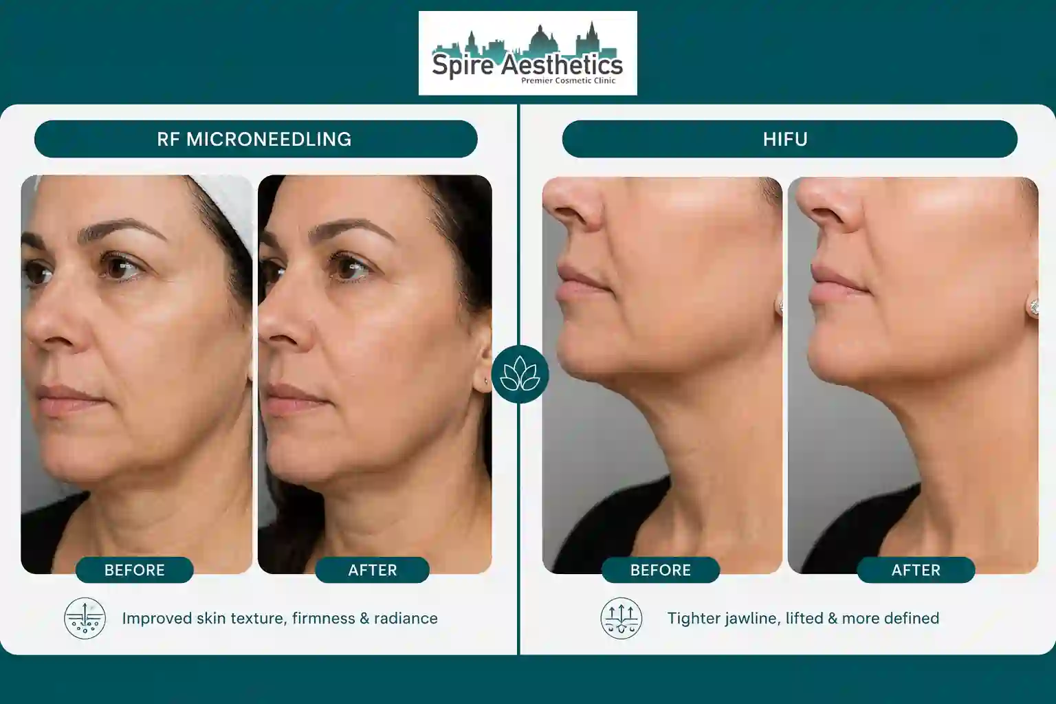 Can RF Microneedling and HIFU Be Combined Bedfordshire?