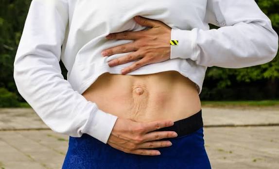 When Could Diastasis Recti Be the Missing Piece of the Puzzle Bedfordshire?